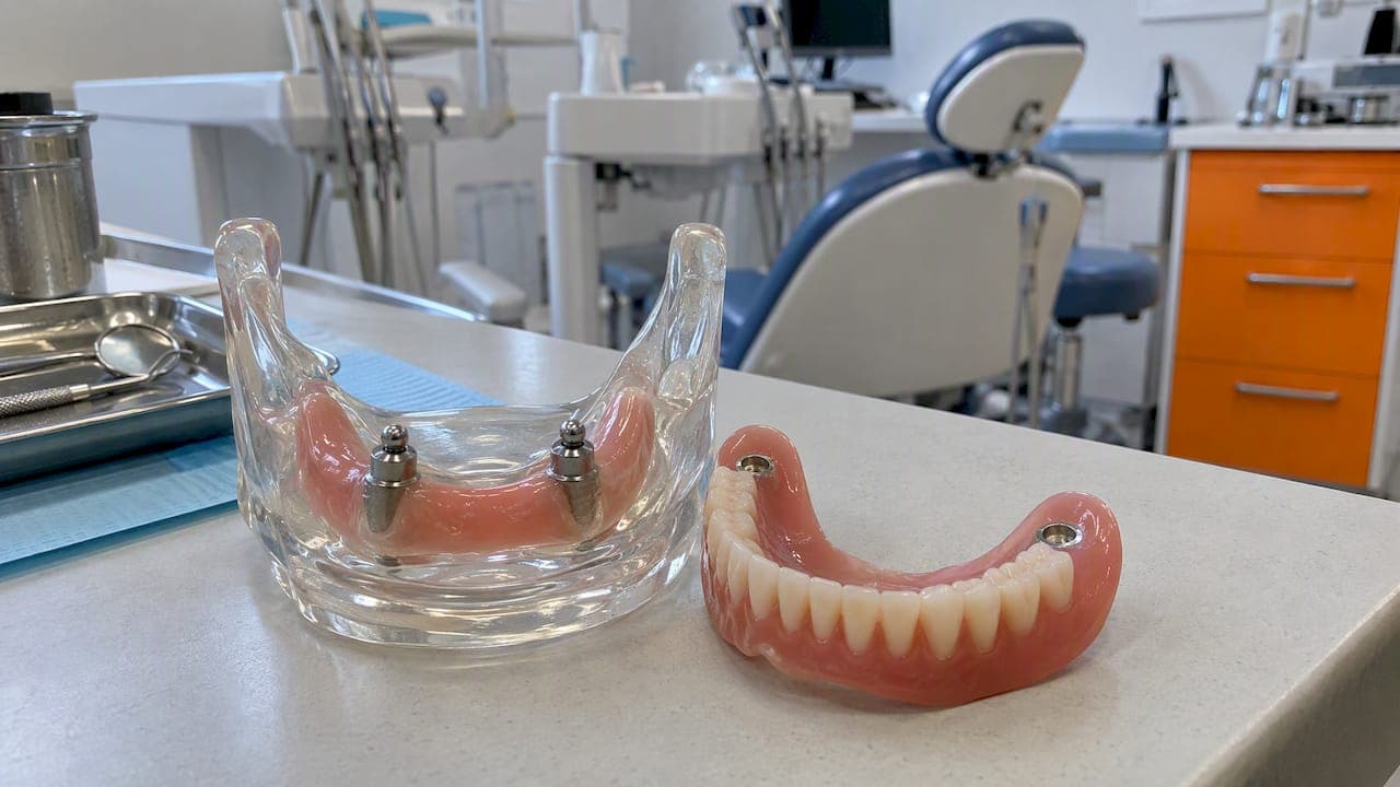Dentures vs Implants: Overdentures Offer Patients a Middle Path